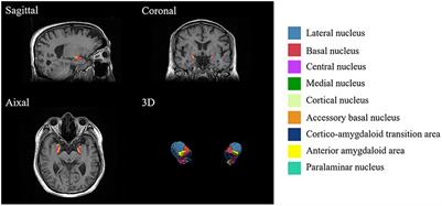 Altered volume of the amygdala subregions in patients with chronic low back pain